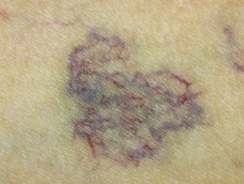 ευρυαγγείες