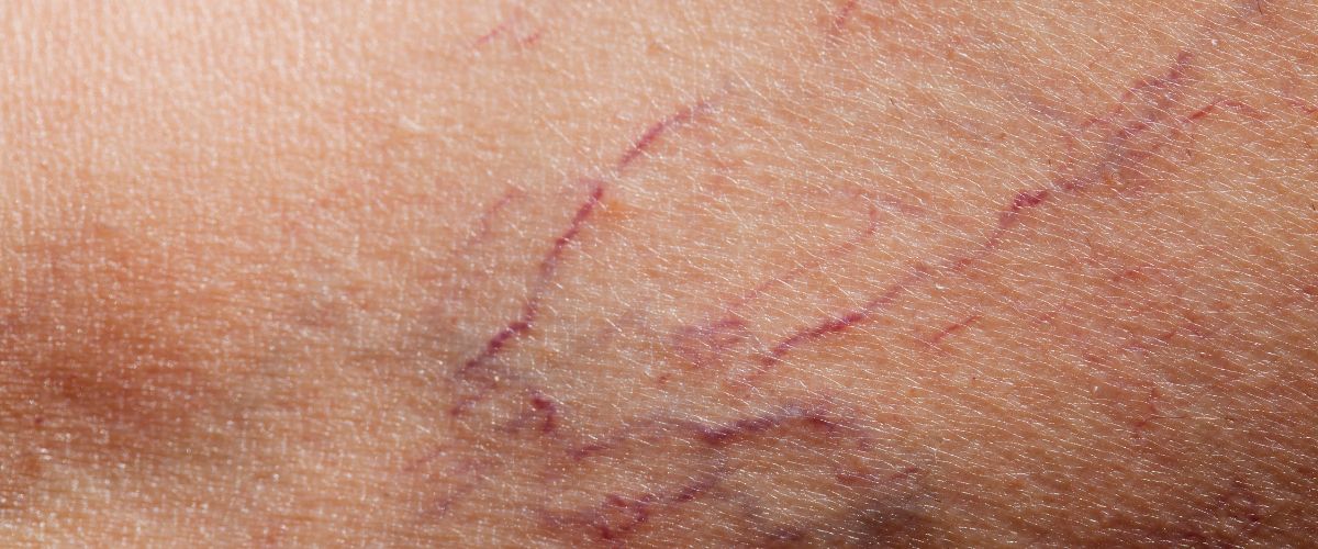 Ευρυαγγείες προσώπου