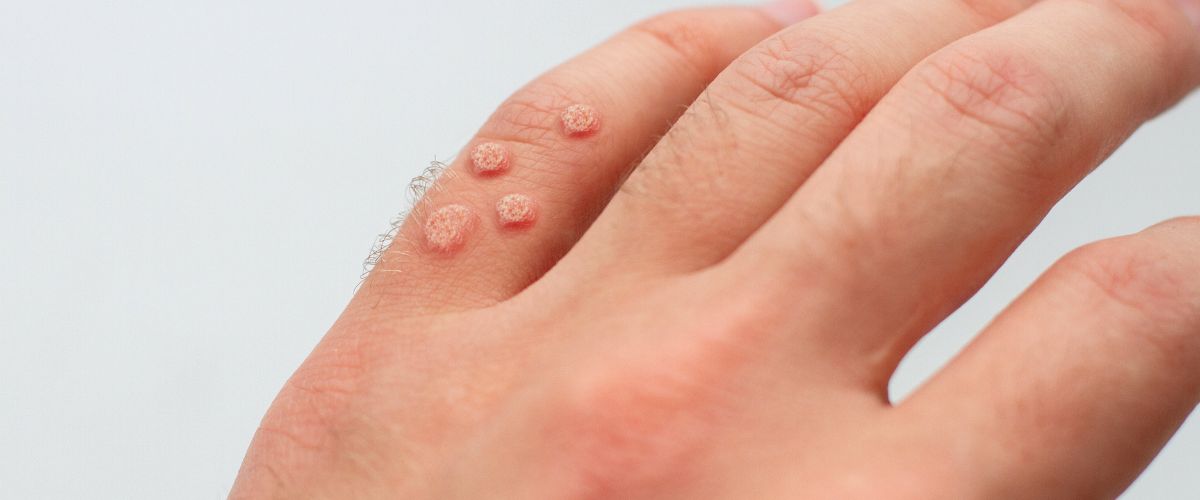 Κονδυλώματα