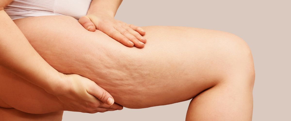 Κυτταρίτιδα