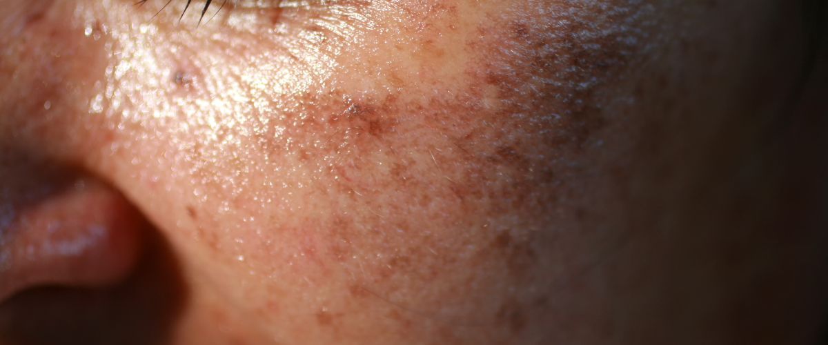 Μελάγχρωση