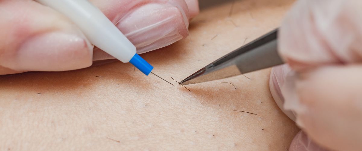 αποτρίχωση με Βελόνα