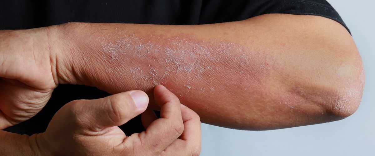 ατοπική δερματίτιδα