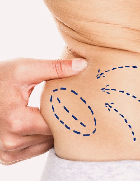 λιποαναρρόφηση