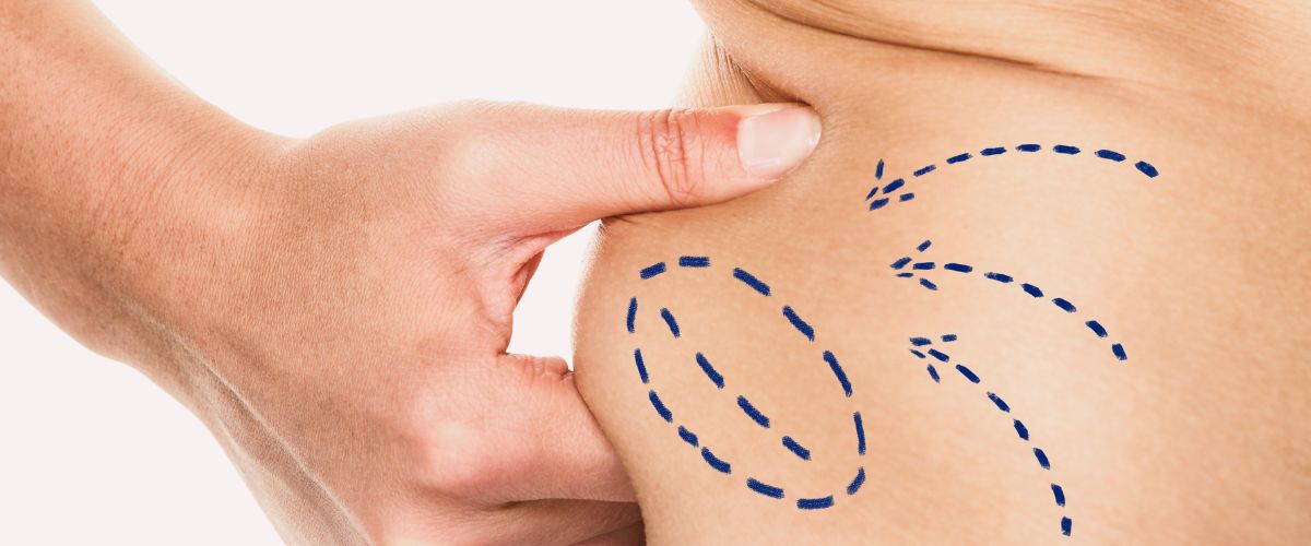 λιποαναρρόφηση