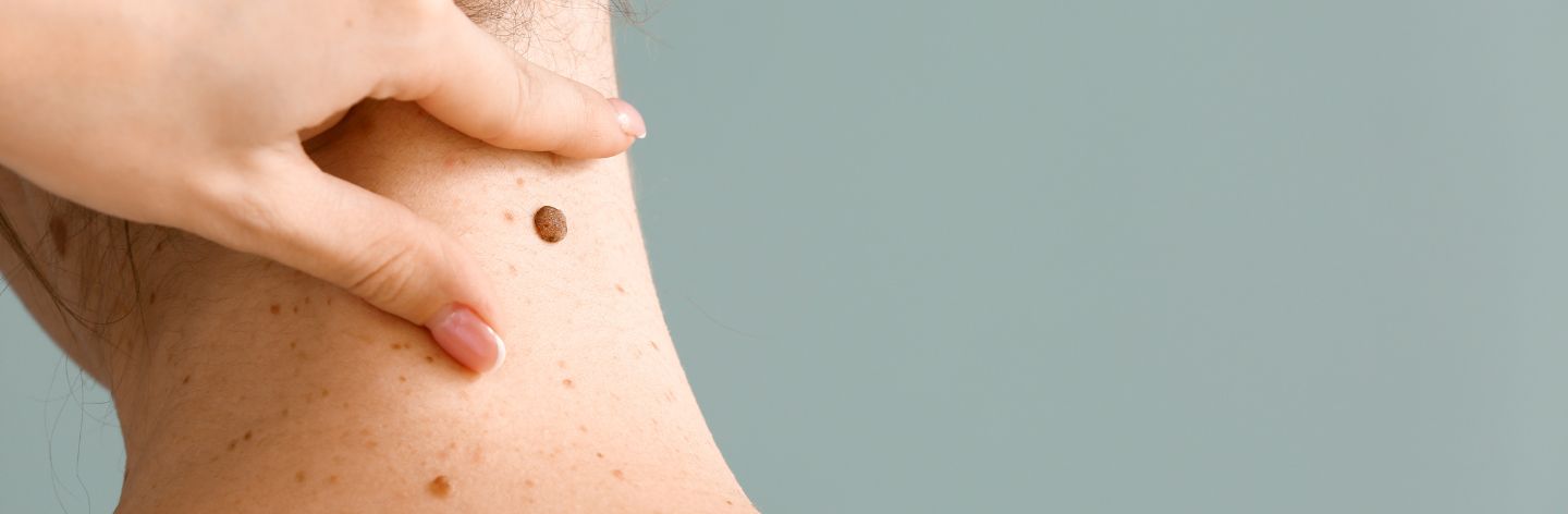 χαρτογράφηση σπίλων