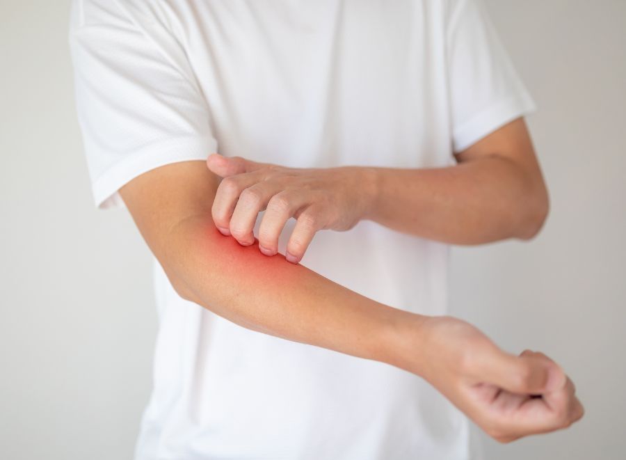 Ατοπική δερματίτιδα